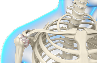 7 Joint Conditions Commonly Associated with Diabetes