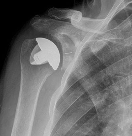x-ray