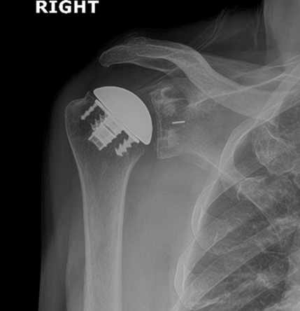 x-ray